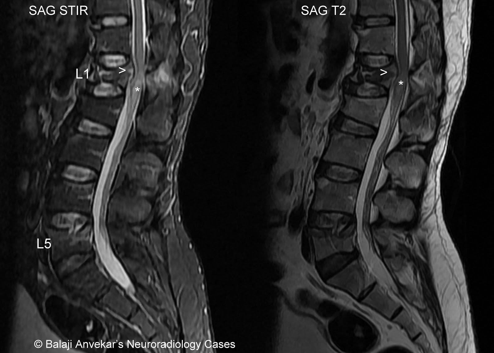 Normal cervical spine mri report multinodular